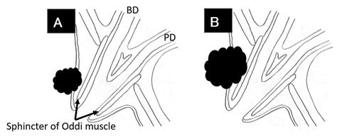 Surgical Strategy For T1 Duodenal Or Ampullary Carcinoma According To The Depth Of Tumor