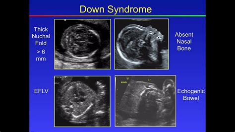 Fetal Congenital Anomalies Part2 Youtube