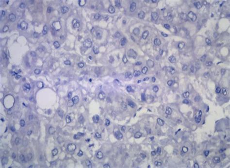 A Positive Immunostaining With Vegf Expression In Hcc B Negative Download Scientific