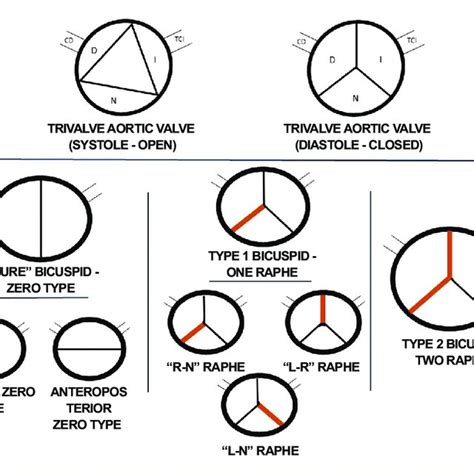 Diagram Of Bicuspid Valve Types Classification According To Sievers And