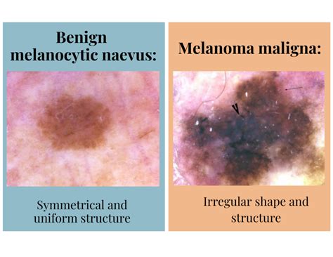 Dermoscopy — DERMAPAMINE by Dermapamine Club