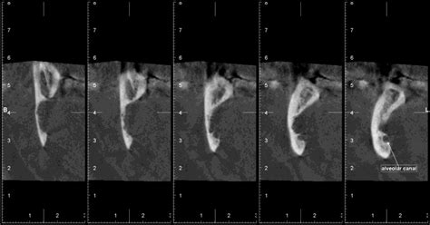 Stafne bone cyst above the inferior alveolar canal | Download ...