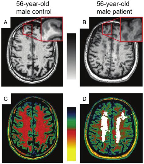 Reduction Of T Contrast Between Gray Matter And Normal Appearing White