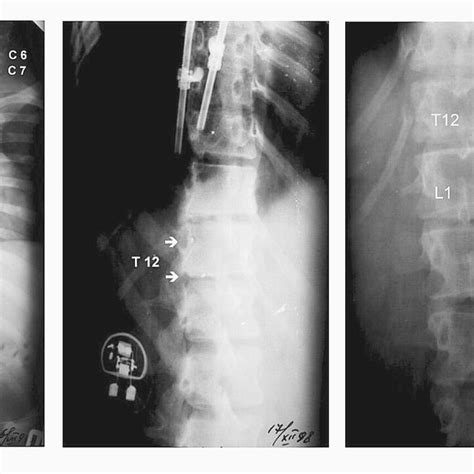 2 X Rays Of The Spine With Stimulating Electrodes A Epidural Download Scientific Diagram