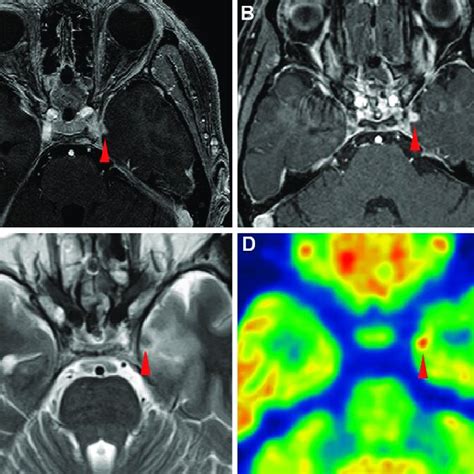 A: MRI reveals a tuberculum sellae meningioma compressing the anterior ...