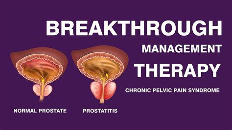 Prostatitis Treatment Male Chronic Pelvic Pain Syndrome Shockwave