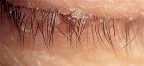 Squamous Blepharitis