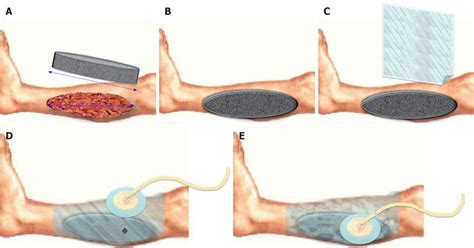 Wound Vac Before And After Pictures