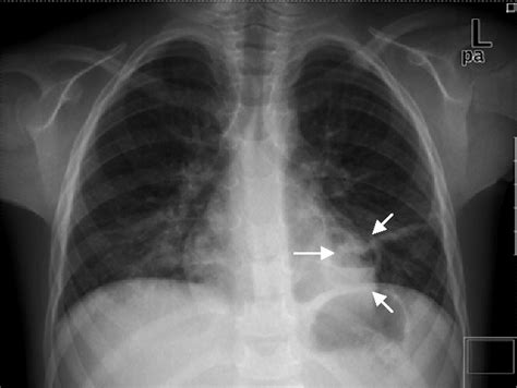 [PDF] Lung Abscess and Pneumatocele After Accidentally Kerosene ...