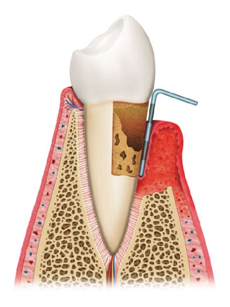 Factors That Can Increase Your Risk Of Periodontal Disease Sanford Dental Excellence