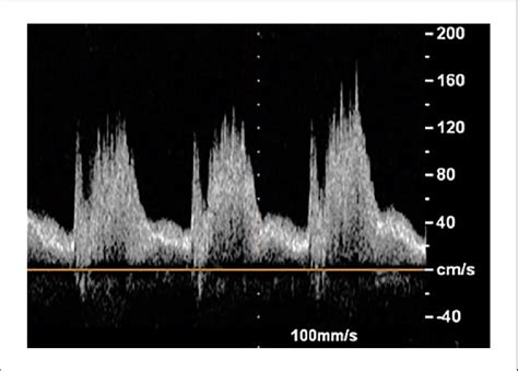 Doppler Flow Pattern Of The Patent Ductus Arteriosus Showing Download Scientific Diagram