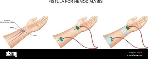 Renal Dialysis Fistula