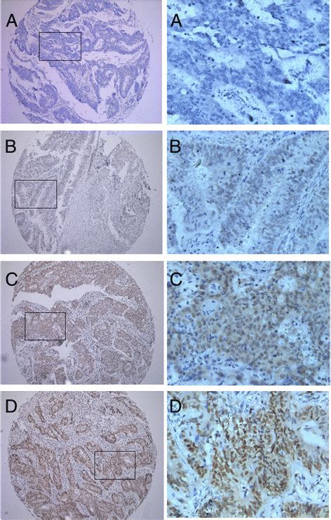 Expression Pattern Of Rfc In Crc By Immunohistochemistry The Low