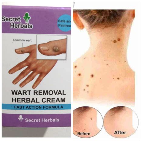wart removal herbal cream  darazlk