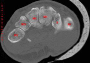 Ct Scan Of The Wrist W Radiology