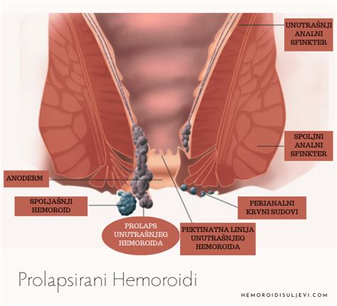 Ta Su Prolapsirani Hemoroidi Hemoroidi Uljevi