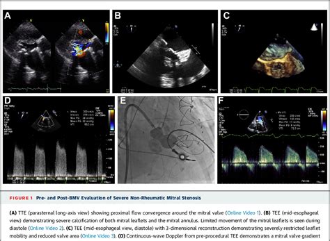 Figure 1 From Transfemoral Balloon Mitral Valvuloplasty For Severe