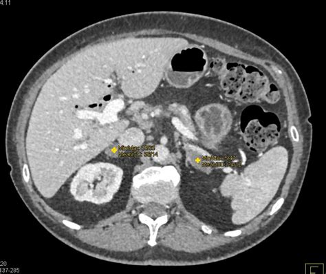 Bilateral Adrenal Adenomas Adrenal Case Studies Ctisus Ct Scanning