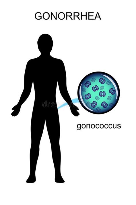 Sexual Infections The Causative Agent Of Gonorrhea Stock Vector Illustration Of Illness