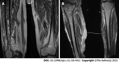 Pancreatitis Panniculitis And Polyarthritis Syndrome A Case Report