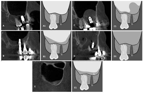 Diagnostics Free Full Text Evaluation Of The Maxillary Sinus Of Patients With Maxillary