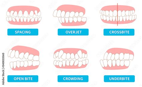 Overjet Vs Overbite