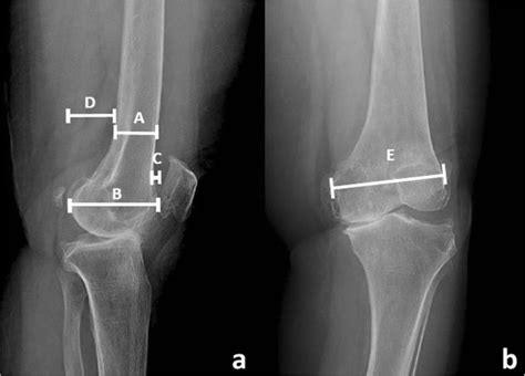 Risk Factors And Outcomes In Asymmetrical Femoral Component Size For