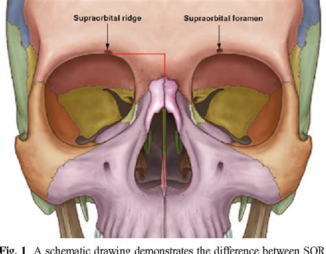 Anatomical Variations Of Supraorbital Notch And Foramen A Study On