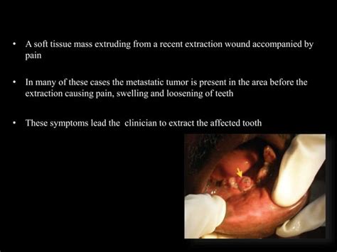 Metastatic Tumors Of Jaws PPT