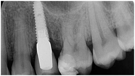Implant Fracture: A Narrative Literature Review