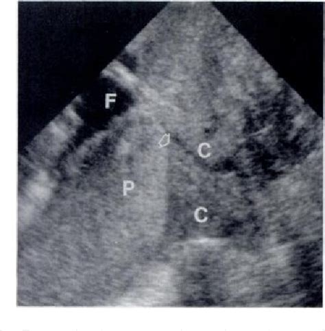 Figure 3 From Diagnosis Of Placenta Previa During The Third Trimester Role Of Transperineal