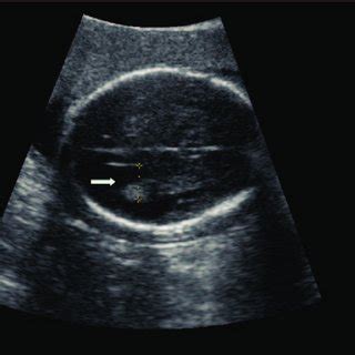 Pdf Fetal Soft Markers In Obstetric Ultrasound