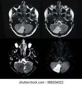 2 806 Brain Stroke Mri Royalty-Free Images, Stock Photos & Pictures ...