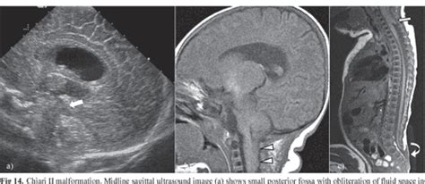 Pdf Neonatal Head Ultrasound Systematic Approach To Congenital