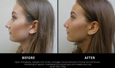 Rhinoplasty London Nose Job Paul Tulley Plastic Surgeon