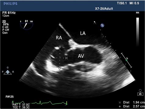 Frontiers Incidental Finding Of An Aorto Right Atrial Fistula In A