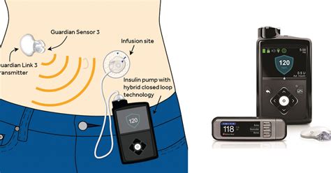 Искусственная поджелудочная железа Medtronic MiniMed 670G поступила в ...