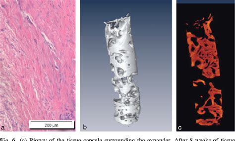 Figure 2 From Soft Tissue Expansion With Self Filling Osmotic Tissue Expanders Before Vertical