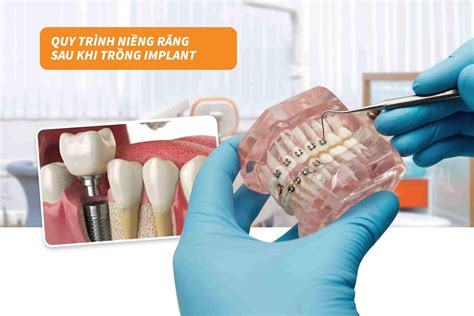 Trồng răng implant có niềng răng được không Thắc mắc Up Dental