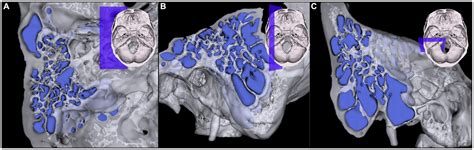 Frontiers The Association Between High Jugular Bulb And Mastoid