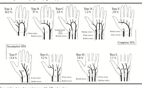 Palmar Arch Study