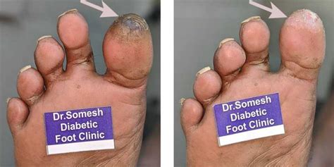 Diabetic Foot Gangrene Stages Great Toe Tip Podiatry Doctor