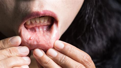 Mucocele De Labio Reporte De Caso 44 OFF