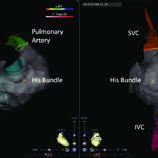 Electroanatomic Map In A Patient Undergoing Left Ventricular