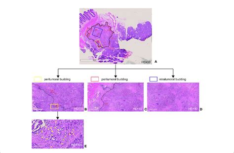 Tumor Budding As Assessed By Large Sections A Example Of A Whole