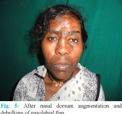 Figure 2 from Face Avulsion and Degloving | Semantic Scholar