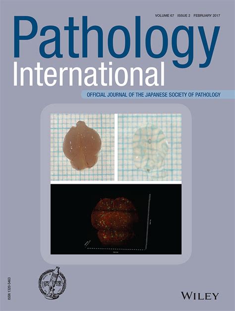 Overexpression Of Cannabinoid Receptor 1 In Esophageal Squamous Cell Carcinoma Is Correlated