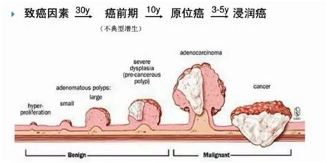 结直肠息肉变成结直肠癌需要多久？95肠癌由这个病演变而来生物探索