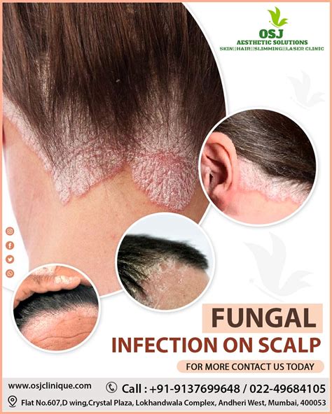 Hair Fungus Treatment Scalp Odor Fungus Causes Of Fungal 54 Off