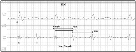 Simultaneous Recording Of Electrocardiogram EKG And Heart Sounds Used